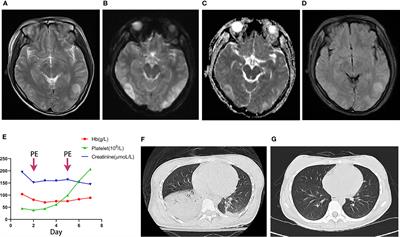 Case Report: Real NPSLE? A patient with systemic sclerosis overlapping systemic lupus erythematosus presenting as epilepsy